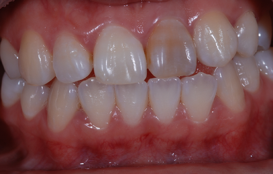 IPS e.max Crown B